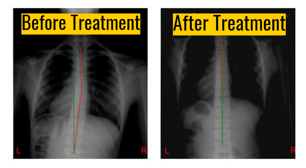 Chiropractic before and after Scoliosis Cincinnati